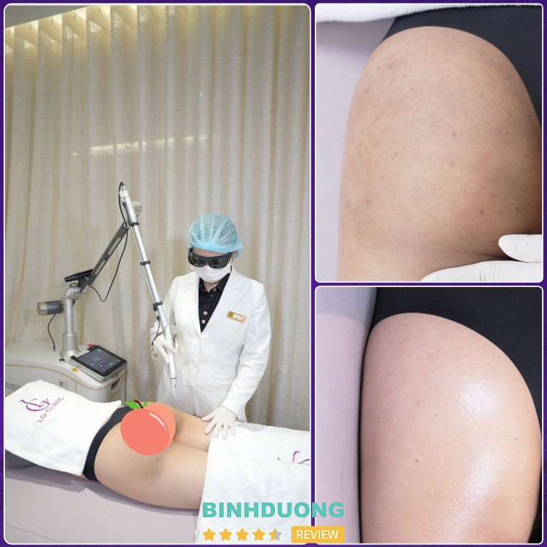 trị thâm mông tại LG Clinic trị thâm mông tại LG Clinic